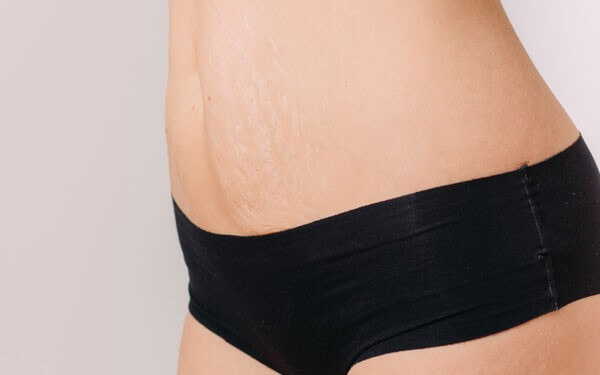 Microdermabrasion for stretch marks